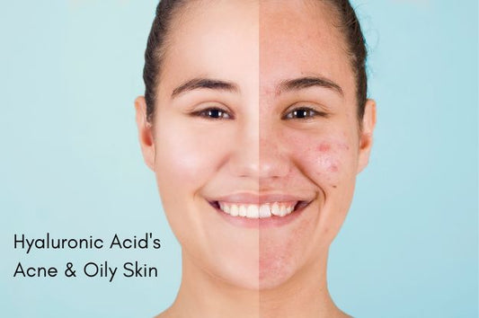 Hyaluronic Acid's Impact on Oily Skin and Acne Woes