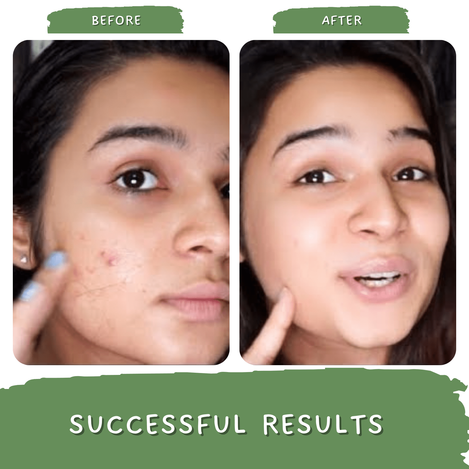 Green Tea Clarity Acne Kit (3 Products) | Complete Regime - before & after results