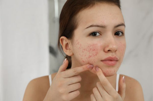 best natural cream for pimples and acne in India