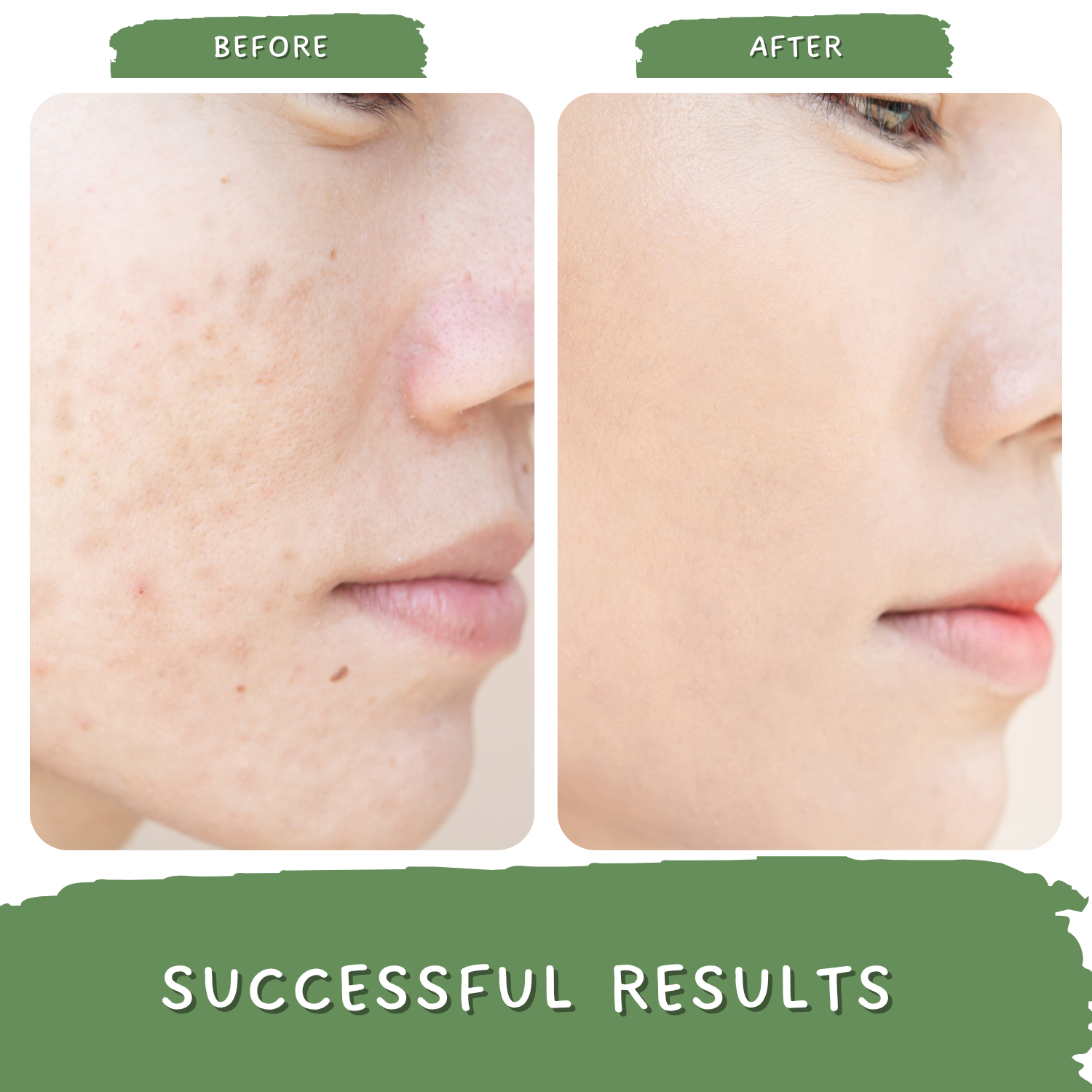 Green Coffee Blemish Clear Cream for Dark Spots and Brighten Skin - Pigmentation Removal Cream